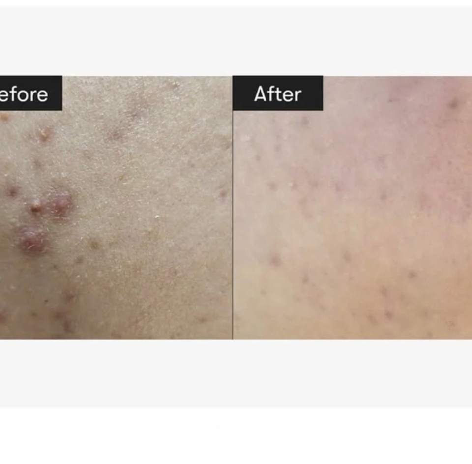 VT Cica Reedle Shot 300 — Intensive Skin Texture Refining & Deep Cica Care